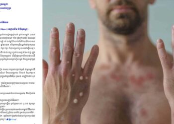 ក្រសួងសុខភិបាលក្រើនរំលឹកឲ្យប្រយ័ត្នខ្លួនពីជំងឺសើរស្បែកម្យ៉ាង ដែល​ទើប​ចម្លងបុរស២នាក់ថ្មីៗ