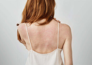 ការកើតមានមុនខ្នងឥតបាត់… អាចបណ្តាលមកពីកត្តាទាំងនេះ!