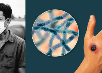 ជំងឺអង់ត្រាក់ Anthrax (ពិសធ្យូង)