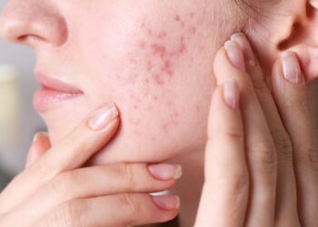 មូលហេតុទាំង ៥ ដែលធ្វើឲ្យមុខអ្នកងាយឡើងមុន