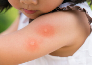 កំណត់សម្គាល់រោគសញ្ញា ជំងឺគ្រុនឈាម