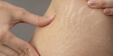 អស់កង្វល់ជាមួយបញ្ហាស្នាមសង្វារដោយវិធីទាំងនេះ